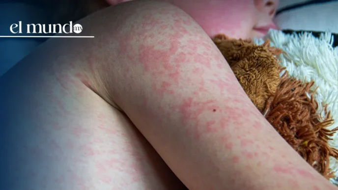 Confirman primera muerte por sarampión en la CDMX; el deceso se registró en 2025